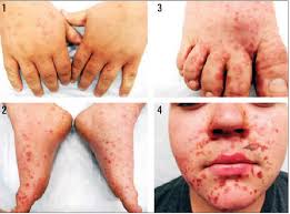 Hand foot and mouth disease pictures, symptoms, causes and. Hand Foot And Mouth Disease Affects Kids More Punch Newspapers