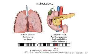 Seyed bashir mirtajani et al, geographical distribution of cystic fibrosis; Neueinfuhrung Kaftrio Bei Mukoviszidose Gelbe Liste