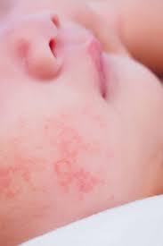 Introducing dairy to milk allergy infant : Allergic Reaction In Baby Treatment And Pictures