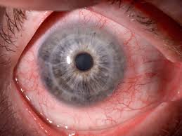 Image result for lesion sclera