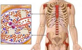 La leucemia cronica può non dare sintomi nelle fasi iniziali mentre quella acuta i sintomi si presentano precocemente e possono peggiorare con estrema rapidità. Leucemia E Leucemia Sintomi Cause