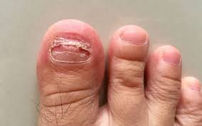 Image result for Pitting nails feet