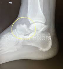 Image result for Ankle XRay