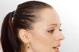 Par exemple, l'alopécie fibrosante frontale, qui touche principalement les. Perte De Cheveux Par Traction Et Trichotillomanie Clauderer