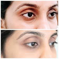 Cost To Remove Dark Circles Under Eyes