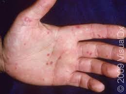 Image result for Hand foot and mouth disease HFMD roof of mouth