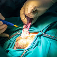 If you are concerned about any changes you experience, please talk with your doctor. Testicular Surgery Preparation Recovery Long Term Care