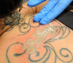 Best hair removal results in pittsburgh. Think Before You Ink Tattoo Removal A 27m Annual Business Triblive Com