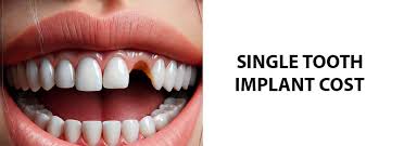 Image result for dental implant