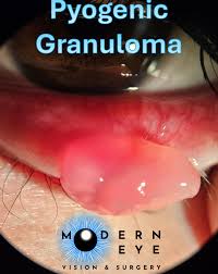 Image result for Pyogenic Granuloma