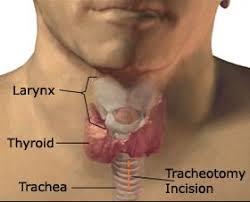 Nurseonlineph December 2013 Nle Results Tracheostomy Care Tracheostomy Tracheostomy Care Nursing Procedures