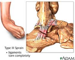 What does it feel like. Thera Band Exercises Effective For Acute Ankle Sprains Performance Health Academy