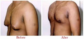 How much does male chest reduction cost uk? Male Breast Reduction In Delhi Gynecomastia Surgery Cost In Delhi Gynecomastia Surgery In Delhi Best Gynecomastia Surgeon In Delhi Dr Vivek Kumar