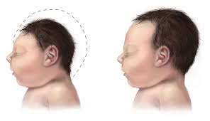 Now say it one more time, ya stuck up little ham! Microcephaly Wikipedia