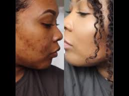 Check spelling or type a new query. How To Cover Dark Spots Hyperpigmentation Makeup Tutorial Youtube