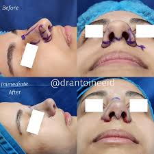 عملية تجميل الانف، النتيجه مباشرة بعد العمليه. عملية تجميل الانف تعتبر من  أكثر العمليات التجميليه تنوعاً، فهي تحتاج لتقنيات متعدده للتعامل مع  النعقيدات المتنوعه التي قد تكون موجوده قبل وخلال العمليه. جرًاح