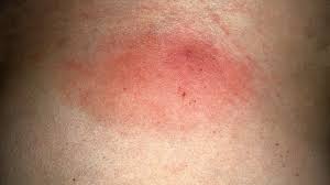 Borreliose Corona Und Viele Zecken Die Zahl Der Borreliose Falle Steigt Bayern 1 Radio Br De