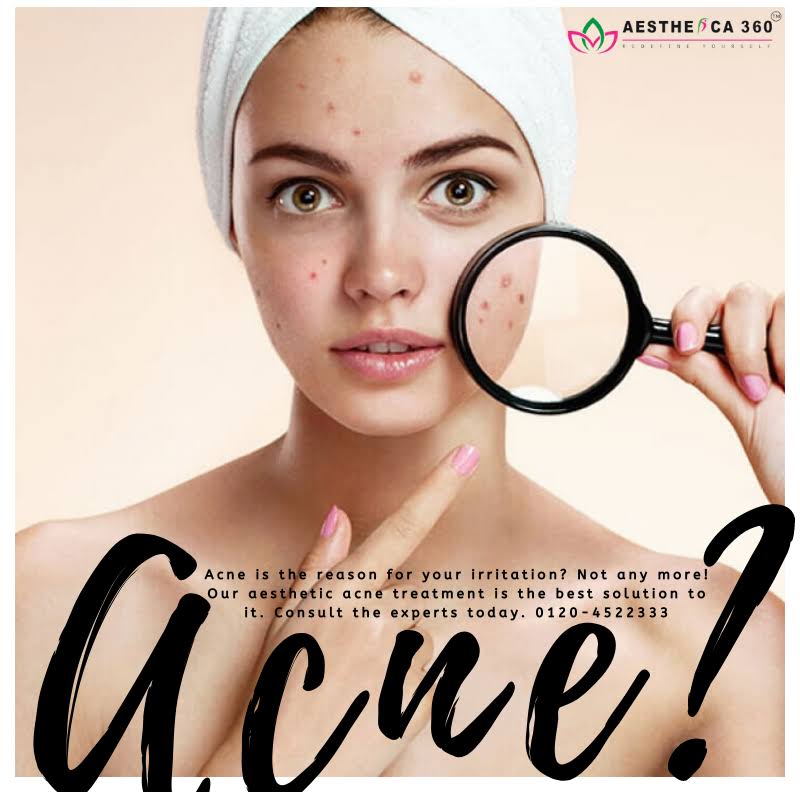 Pimples & Acne Treatment product image