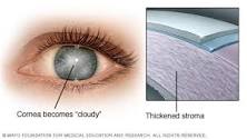 Image result for icd 10 code for fuchs dystrophy left eye