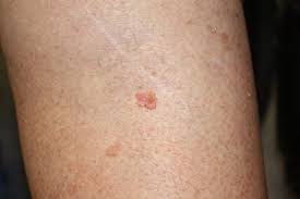 Image result for Cancer Symptom