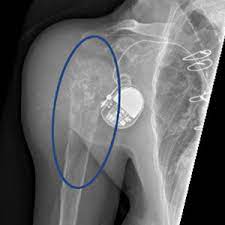 Morgan department of radiology & radiological science, the johns hopkins. Bone Lesions Benign And Malignant Bone Growth Abnormalities
