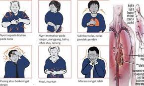 Satu kajian yang melihat perbezaan simptom serangan jantung antara lelaki dan wanita juga menemui yang beberapa wanita yang tak mengalami tanda serangan jantung biasa tak. Warisan Ana Mahabu Bismillahirrahmaanirrahim Inilah Tanda Tanda Gejala Penyakit Jantung Yang Selalu Muncul Satu Bulan Sebelum Serangan Kerana Itu Peluang Ini Kita Akan Membahas Beberapa Tanda Dan Tanda Tanda Penyakit Jantung Yang Perlu