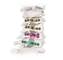 Laminoplasty Plate System,Medical Device Manufacturers ...