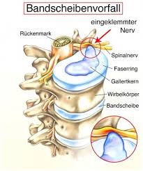 Bandscheibenvorfall An Der Halswirbelsaule Ursachen Beschwerden Therapie Gesundpedia De