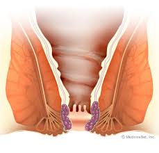 How To Get Rid Of Hemorrhoids Types Treatment Symptoms Causes