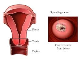 Image result for Cervical Cancer Screening