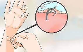 It can be very common when shaving to have a hair but, it seems an ingrown nose hair is much worse. Pulling Out Or Popping Ingrown Hair When They Hurts Itchy