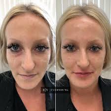 Click here to subscribe, it's free! Best Dermal Fillers In Vancouver Bc
