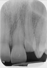 Image result for Tooth Luxation