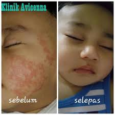 Bayangkan dia punya pedih macam mana. Klinik Avicenna Ada Eczema Penyakit Kulit Kurap X Facebook