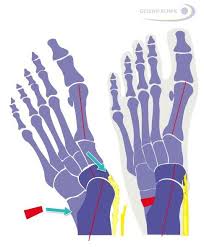 Die fehlstellung nimmt aber immer mehr zu. Knick Senkfuss Schwache Der Tibialis Posterior Sehne Gelenk Klinik De