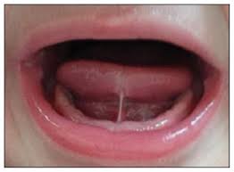 Image result for Ankyloglossia