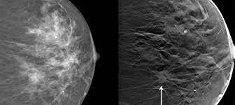 A mammogram can show breast changes such as calcifications, masses, or other symptoms that might be cancer. What Is 3 D Mammography Duke Health