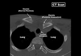 Image result for SC Dislocation
