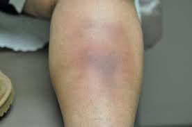 Image result for Panniculitis