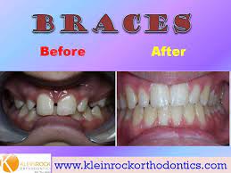 Severe Overbite Correction After Braces Overbite Correction Braces Before And After