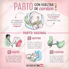 Vueltas De Cordon Umbilical Parto Imagenes De Embarazo Sintomas De Embarazo Dilatacion Parto