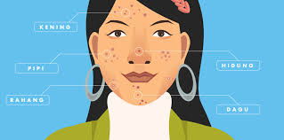 Jerawat di dagu biasanya terjadi pada wanita berusia 25 tahun ke atas. Jerawat Di Pipi Artinya Bukan Lagi Jatuh Cinta Tapi Ini