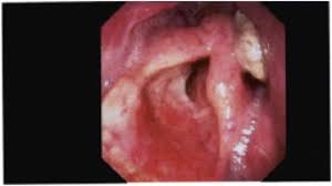 Merkel cell carcinoma of the skin is a rare form of skin cancer. Seed And Soil Pharyngeal Merkel Cell Carcinoma After Radiotherapy For Laryngeal Squamous Cell Carcinoma Sciencedirect