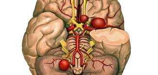 Aneurysms are usually found at the base of the brain just inside the skull, in an area called the subarachnoid space. Brain Aneurysm Treatment Market Research Analysis With Quantitative Research By Type Surgery Medication And Condition To Impact On The Industry Over 2023 Medgadget