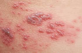 Secara umum, pengertian awan adalah kumpulan tetesan air atau kristal es di dalam atmosfer yang terjadi karena adanya. Kayap Kesinambungan Daripada Chickenpox Hello Doktor
