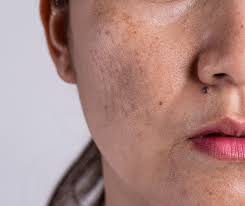 Image result for Melasma
