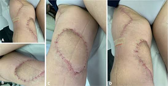 Sarcoma Surgery