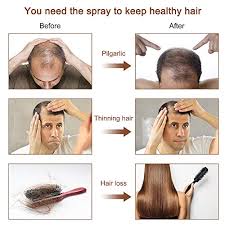 However, if you are starting at the first signs of a receding hairline, you can stop the recession and potentially grow back the small amount of lost hair. Hair Grow Spray Anti Hair Loss Thinning Balding Natural Ingredients Hair Regrowth Treatment For Stronger Thicker Longer Hair Grow Repair Hair Follicles All Hair Types Men And Women Pricepulse