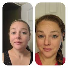 Who here suffers with Age Spots or Sun Spots??