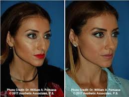 Rhinoplasty Nose Surgery Photo Gallery Rhinoplasty 1 Before After Rhinoplasty 2 Before After Rhinoplasty 3 Before After Rhi Rhinoplasty Nose Surgery Nose Job
